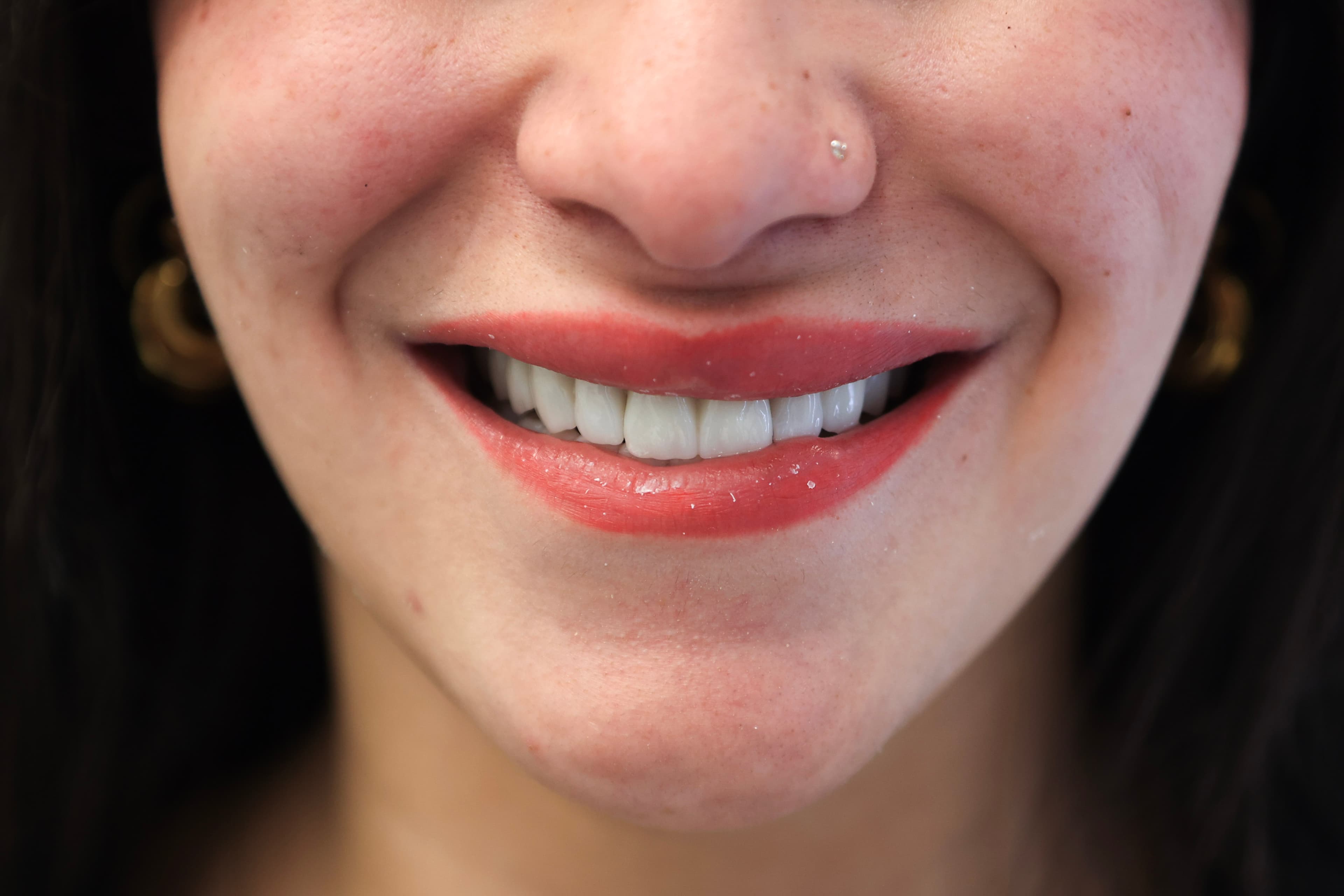 Lela Dental before and after treatment result after