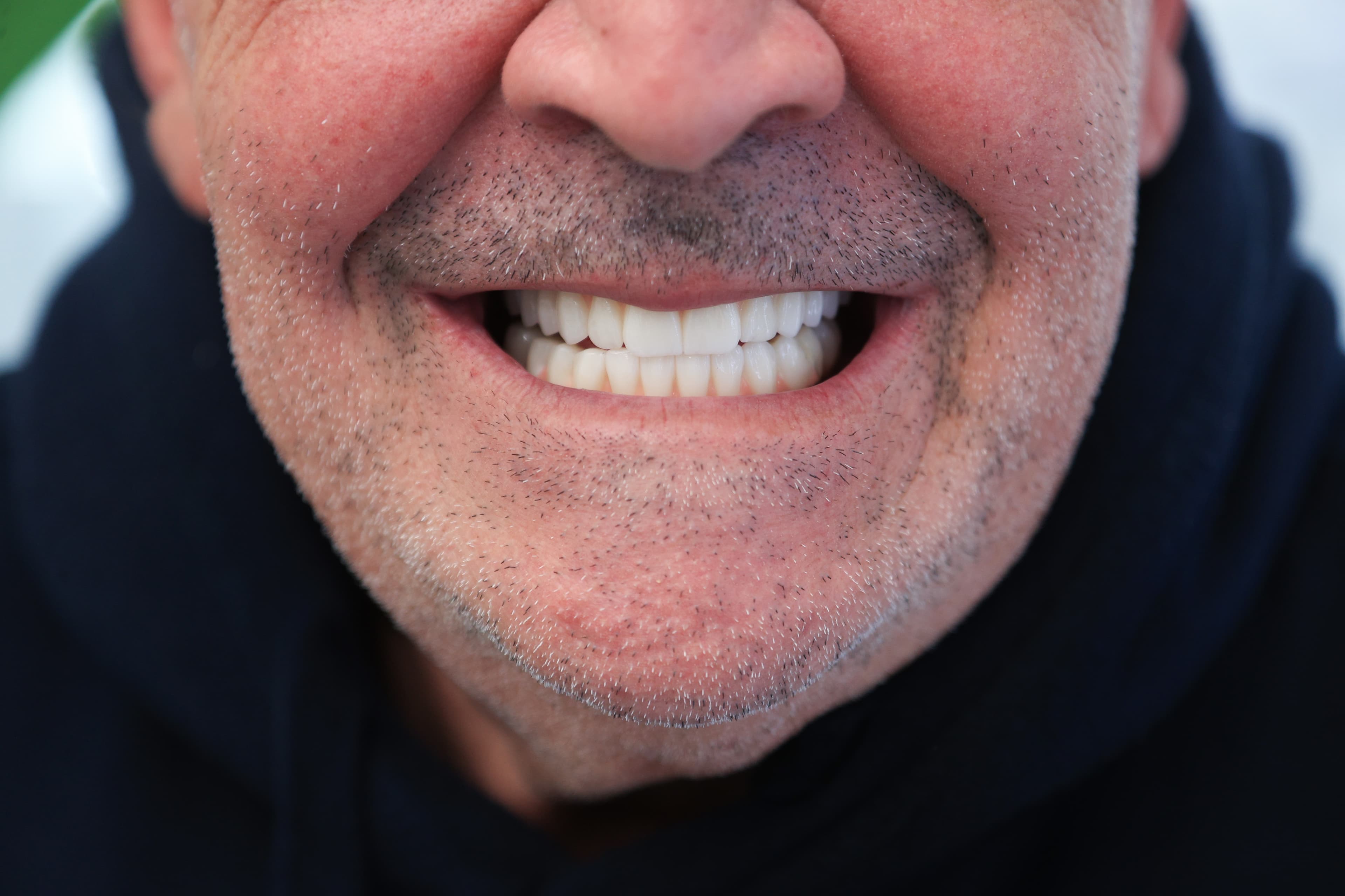 Lela Dental before and after treatment result after