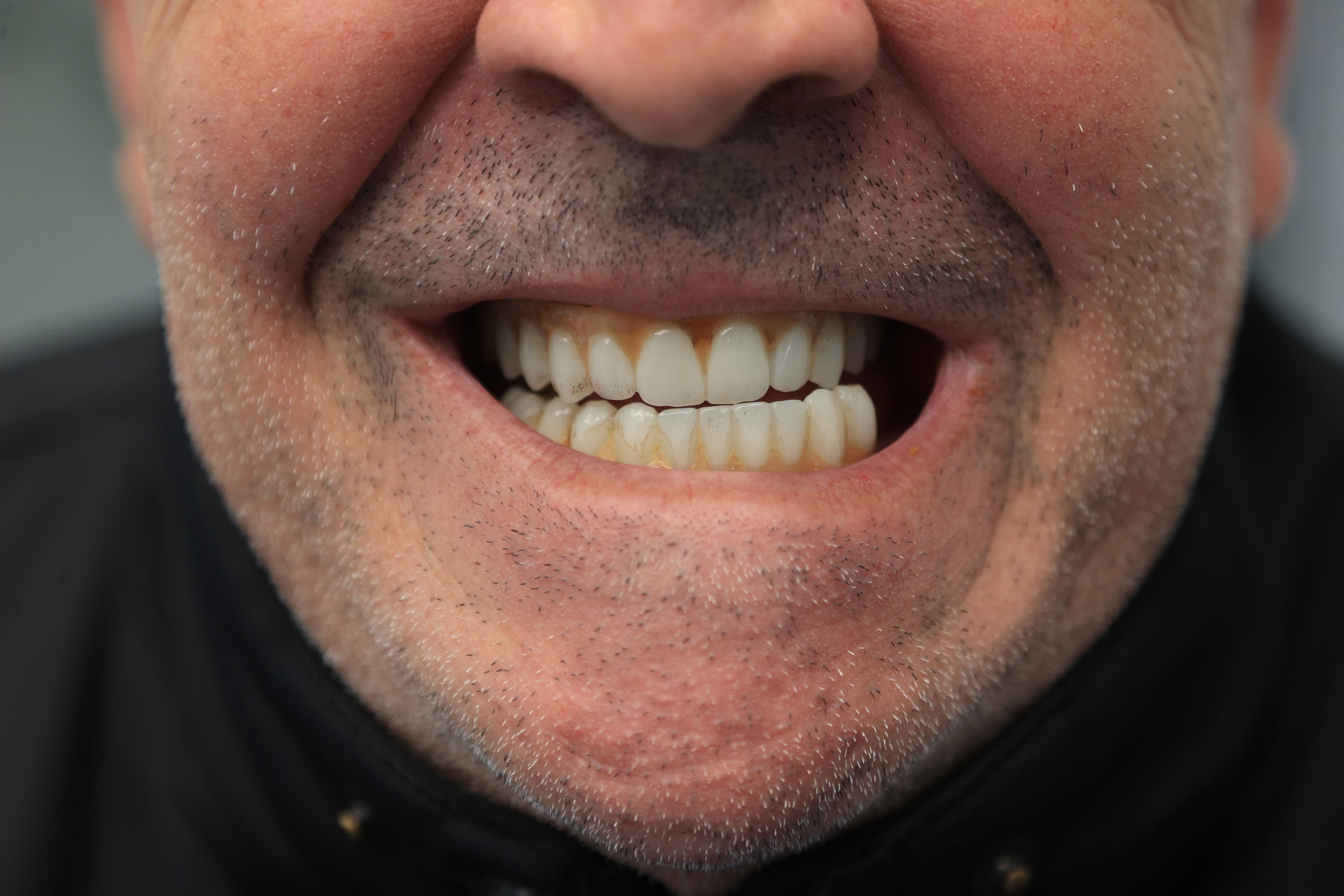 Lela Dental before and after treatment result before