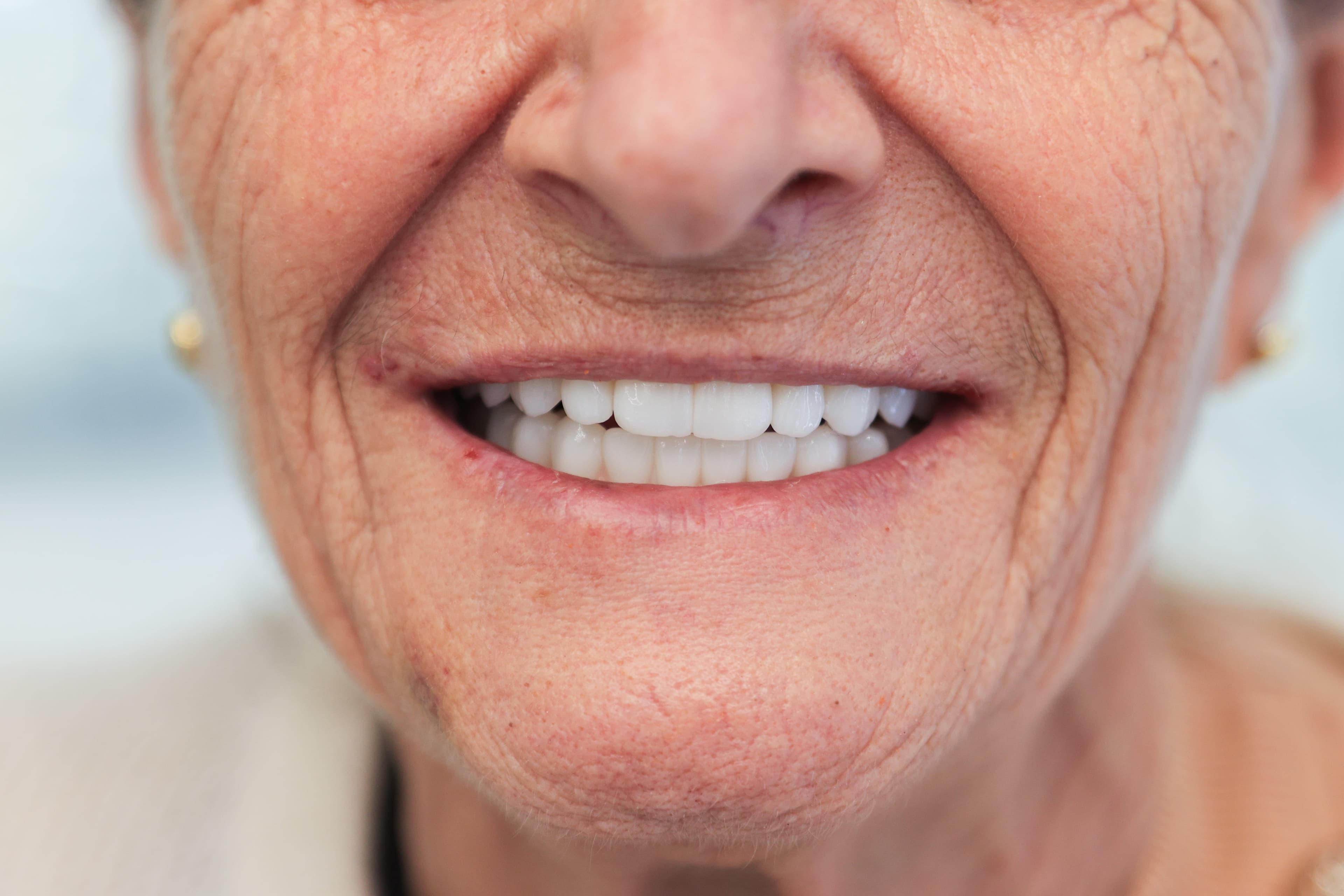 Lela Dental before and after treatment result after