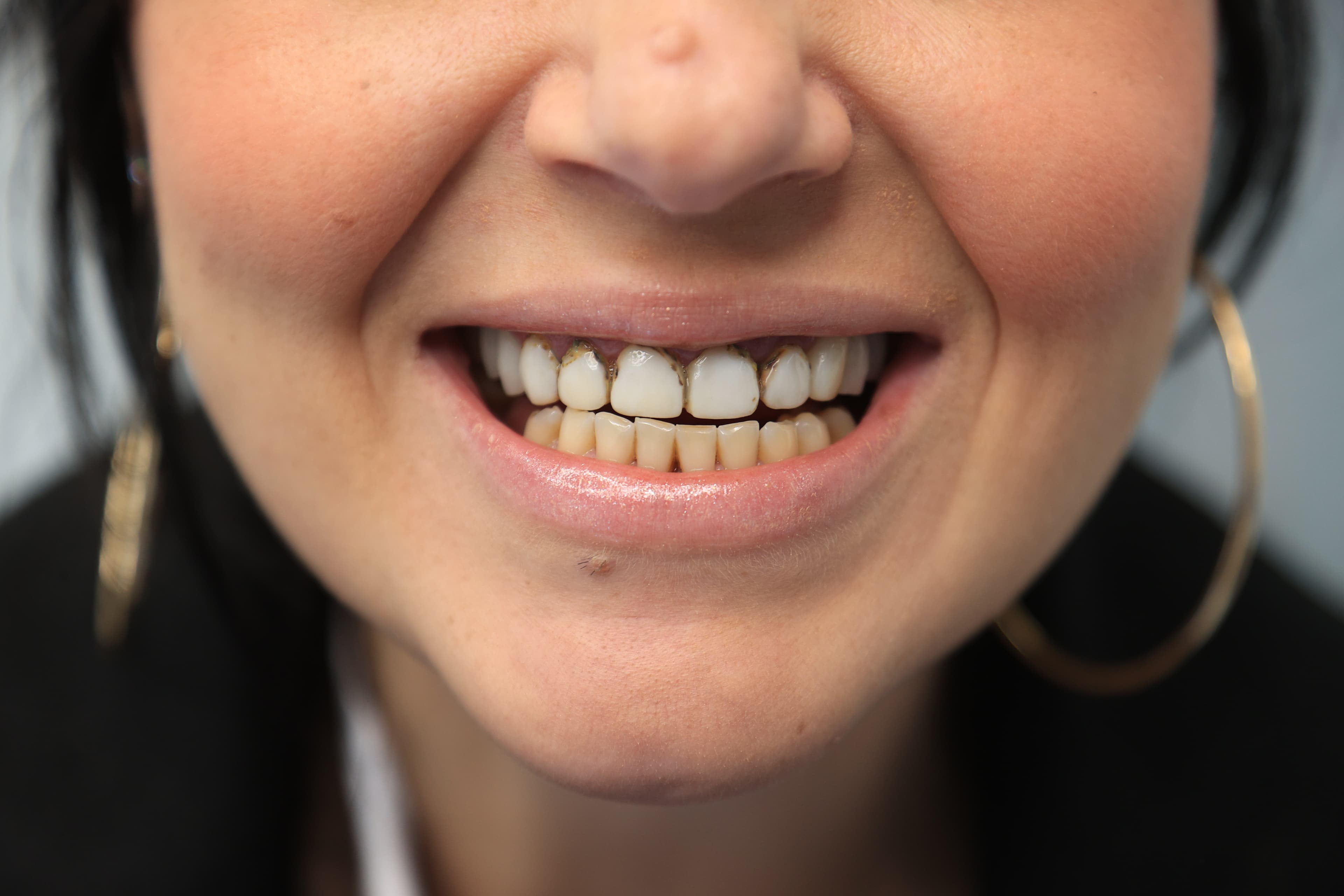 Lela Dental before and after treatment result before