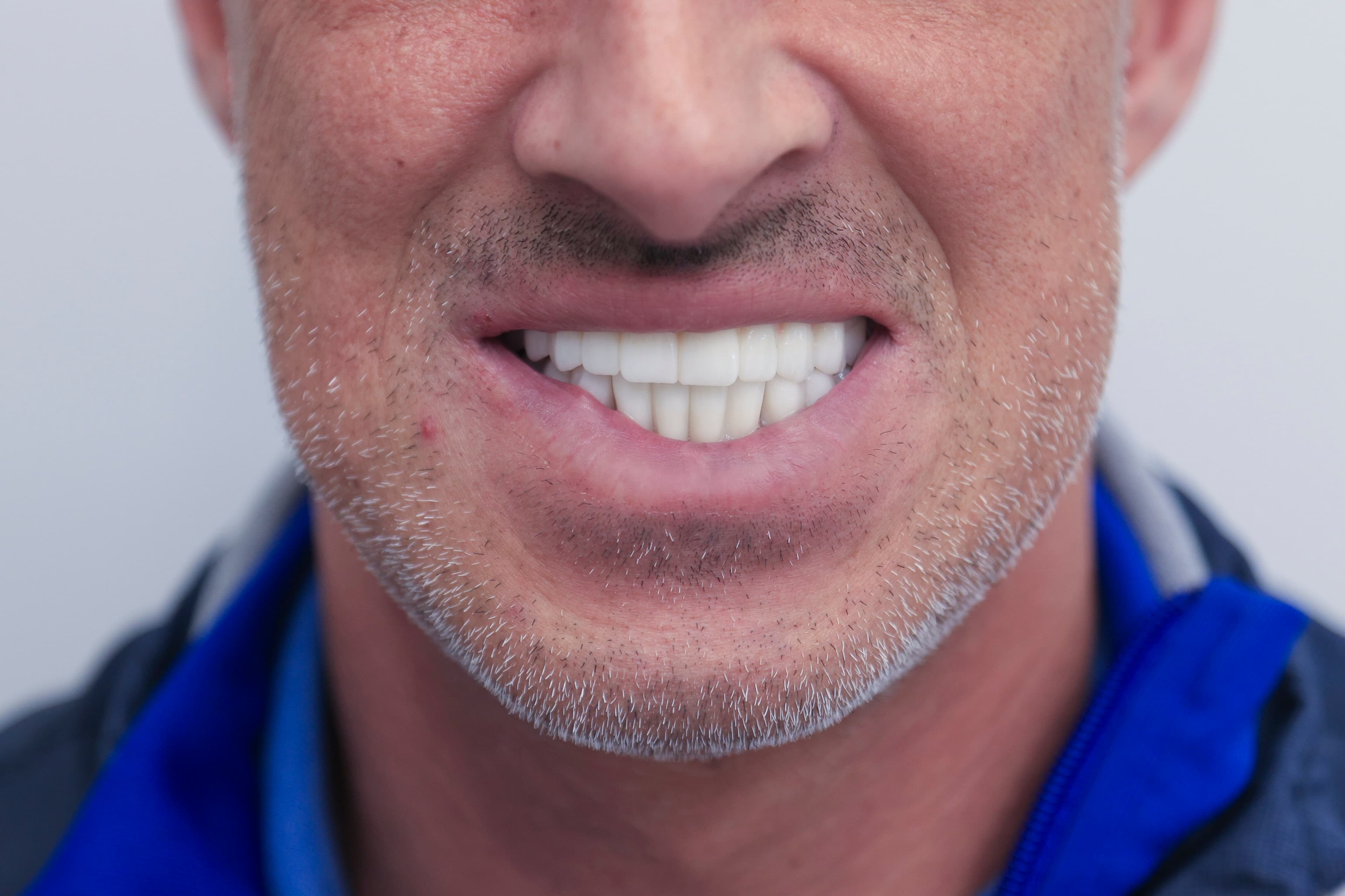 Lela Dental before and after treatment result after