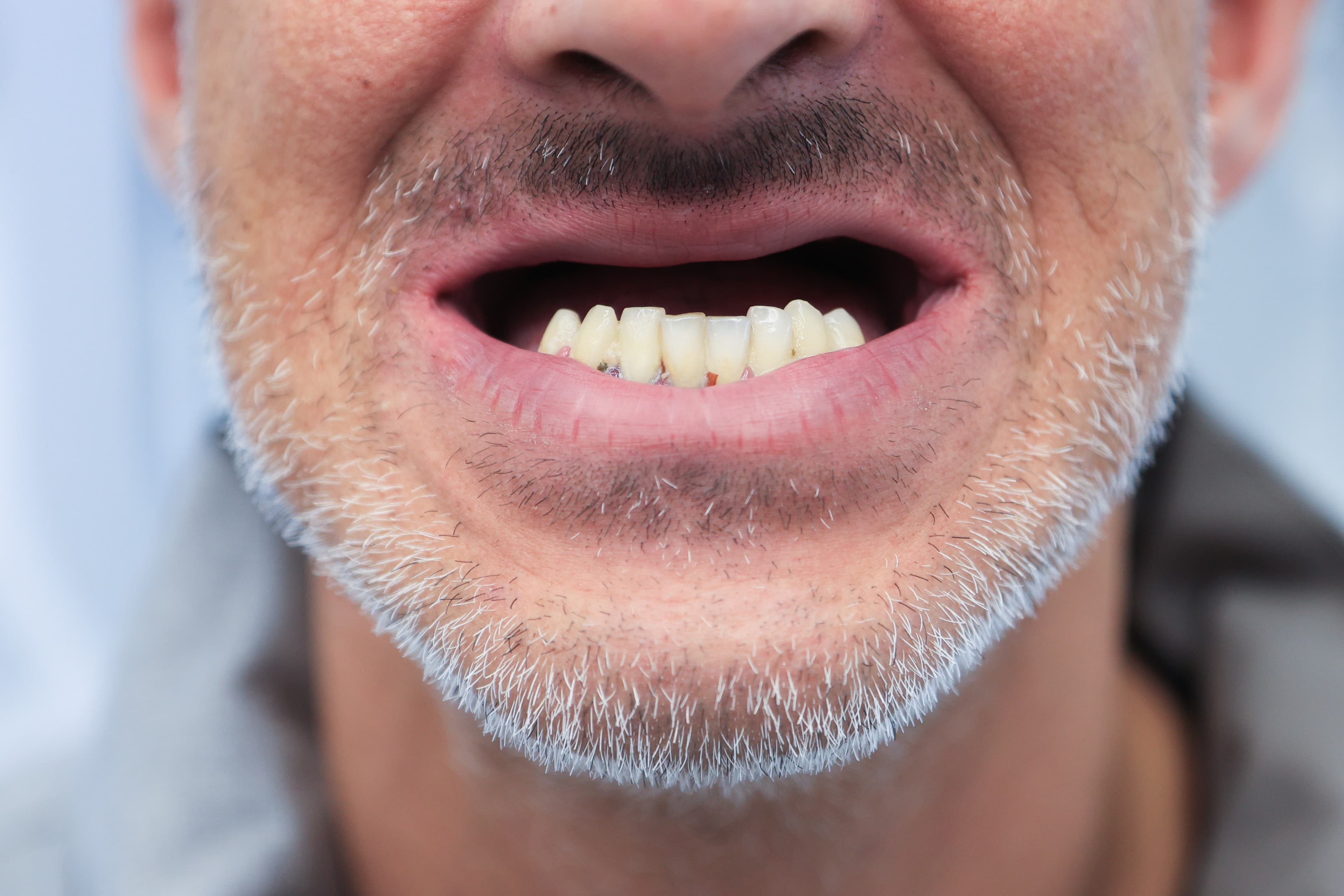 Lela Dental before and after treatment result before